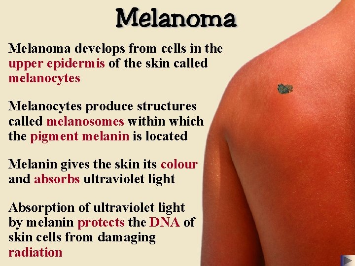 Melanoma develops from cells in the upper epidermis of the skin called melanocytes Melanocytes