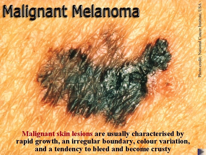 Malignant skin lesions are usually characterised by rapid growth, an irregular boundary, colour variation,