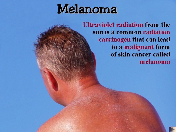 Ultraviolet radiation from the sun is a common radiation carcinogen that can lead to