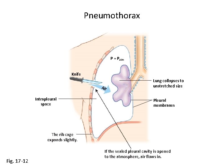 Pneumothorax P = Patm Knife Air Intrapleural space Lung collapses to unstretched size Pleural