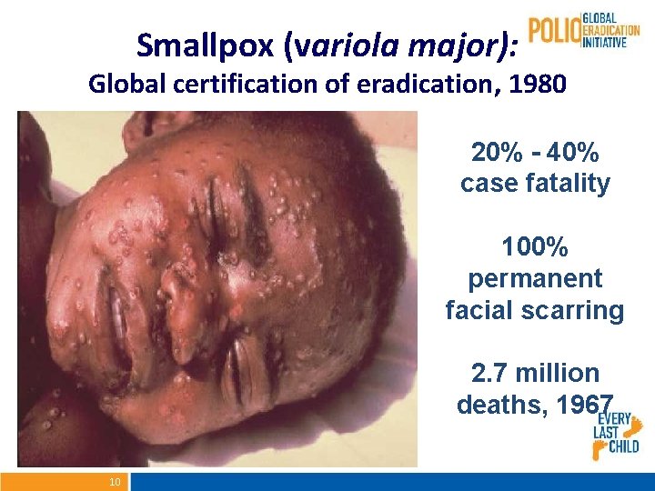 Smallpox (variola major): Global certification of eradication, 1980 20% - 40% case fatality 100%
