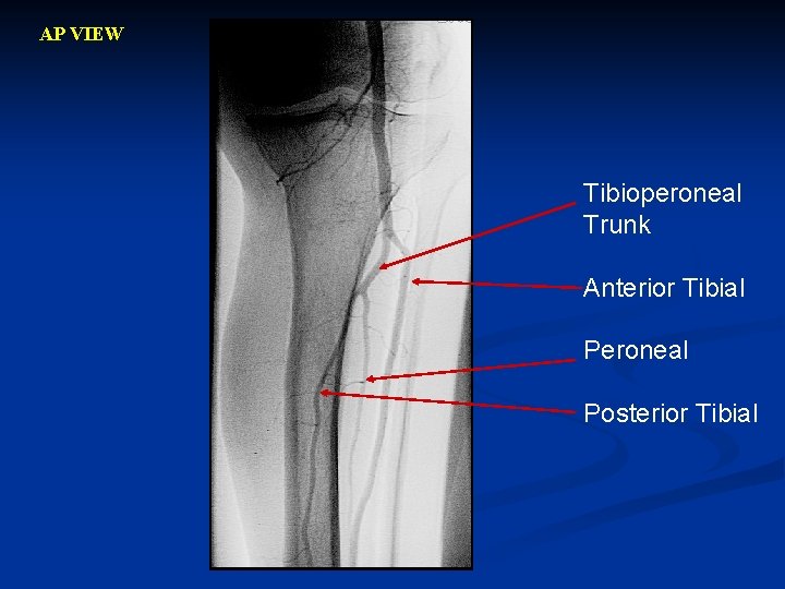AP VIEW Tibioperoneal Trunk Anterior Tibial Peroneal Posterior Tibial 