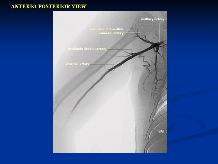 ANTERIO-POSTERIOR VIEW 