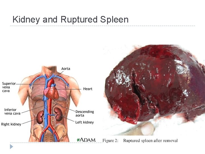 Kidney and Ruptured Spleen 