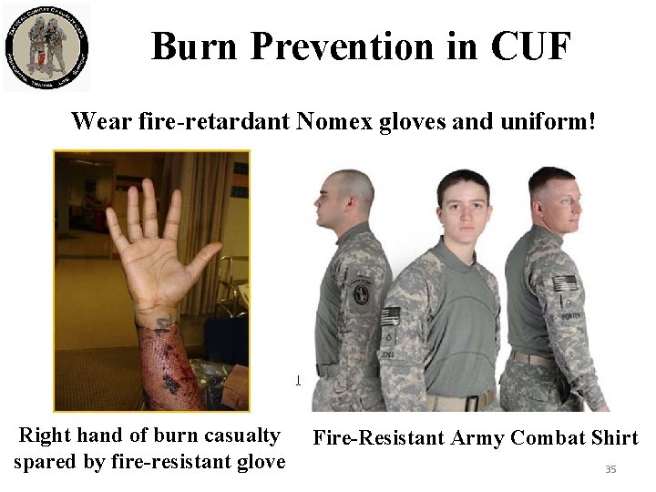 Burn Prevention in CUF Wear fire-retardant Nomex gloves and uniform! Right hand of burn