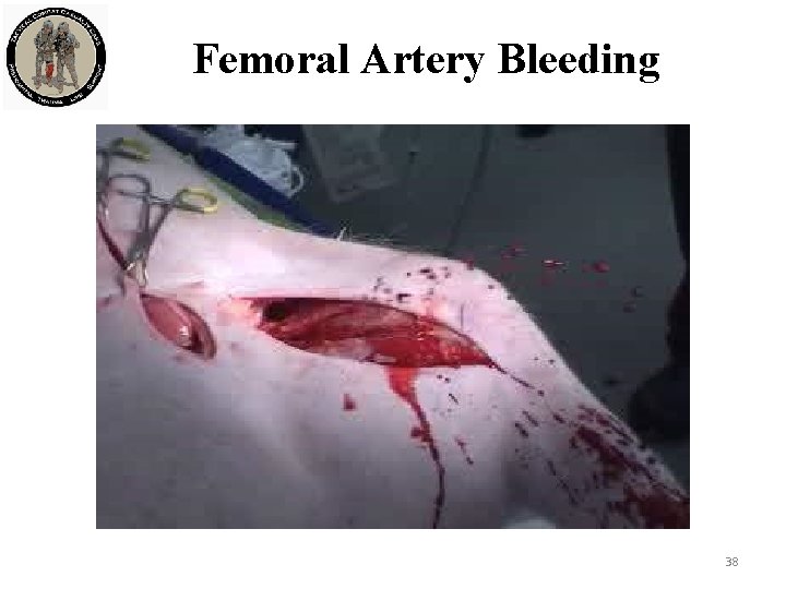 Femoral Artery Bleeding 38 