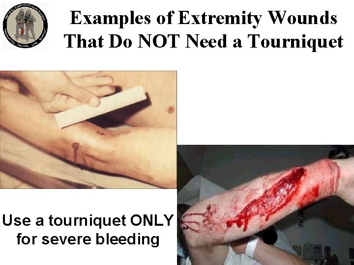 Examples of Extremity Wounds That Do NOT Need a Tourniquet Use a tourniquet ONLY