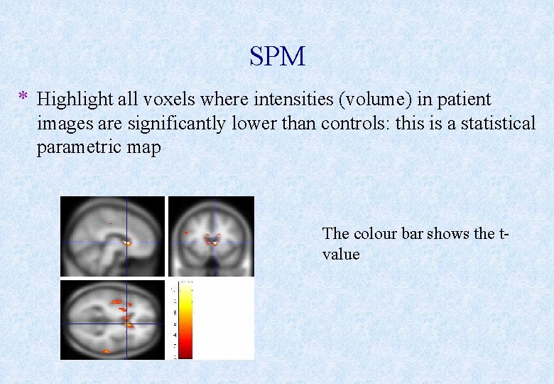 SPM * Highlight all voxels where intensities (volume) in patient images are significantly lower