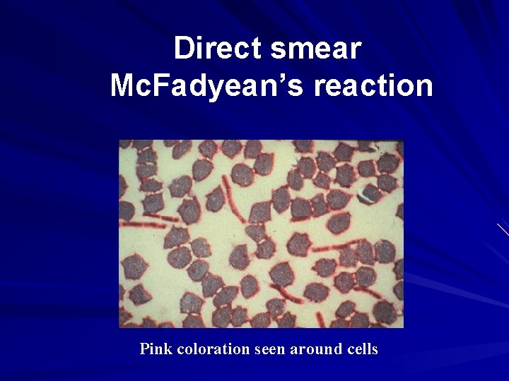 Direct smear Mc. Fadyean’s reaction Pink coloration seen around cells 