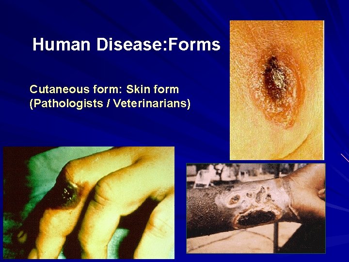Human Disease: Forms Cutaneous form: Skin form (Pathologists / Veterinarians) 