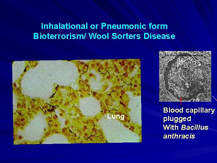 Inhalational or Pneumonic form Bioterrorism/ Wool Sorters Disease EM: Blood vessel with anthrax Lung
