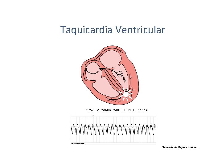 Taquicardia Ventricular 12: 57 29 MAR 96 PADDLES X 1. 0 HR = 214