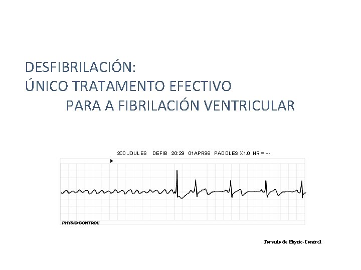 DESFIBRILACIÓN: ÚNICO TRATAMENTO EFECTIVO PARA A FIBRILACIÓN VENTRICULAR 300 JOULES DEFIB 20: 29 01