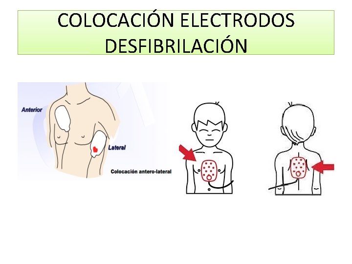 COLOCACIÓN ELECTRODOS DESFIBRILACIÓN 