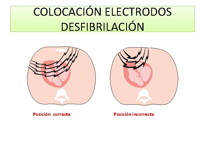 COLOCACIÓN ELECTRODOS DESFIBRILACIÓN Posición correcta Posición incorrecta 