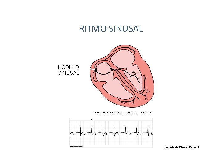 RITMO SINUSAL NÓDULO SINUSAL 12: 56 29 MAR 96 PADDLES X 1. 0 HR