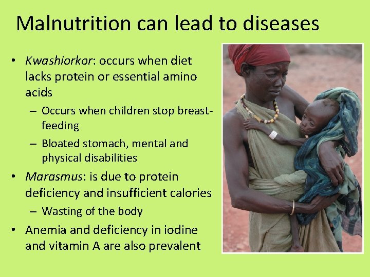 Malnutrition can lead to diseases • Kwashiorkor: occurs when diet lacks protein or essential