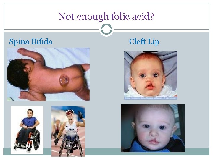 Not enough folic acid? Spina Bifida Cleft Lip 