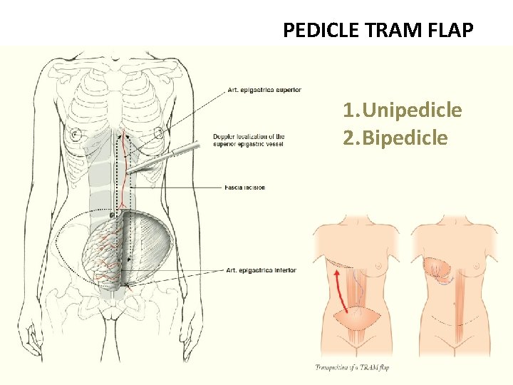 PEDICLE TRAM FLAP 1. Unipedicle 2. Bipedicle 