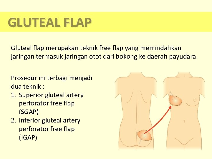GLUTEAL FLAP Gluteal flap merupakan teknik free flap yang memindahkan jaringan termasuk jaringan otot