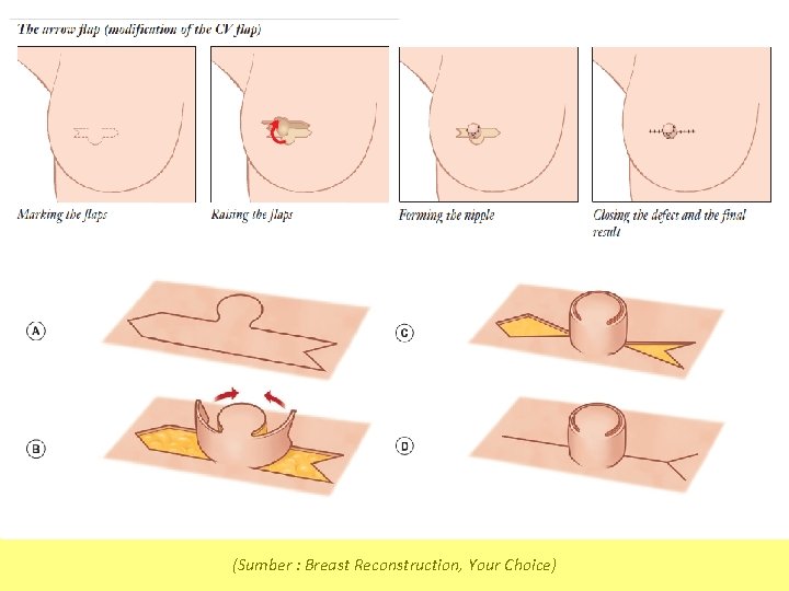 (Sumber : Breast Reconstruction, Your Choice) 