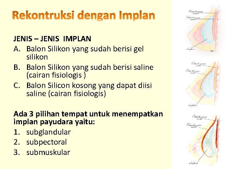 JENIS – JENIS IMPLAN A. Balon Silikon yang sudah berisi gel silikon B. Balon