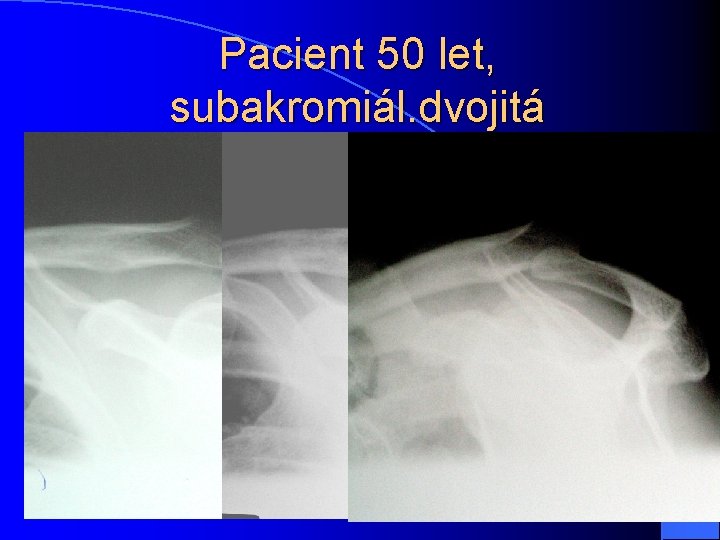 Pacient 50 let, subakromiál. dvojitá paraartikulární kalcifikace 10 x 8 mm 