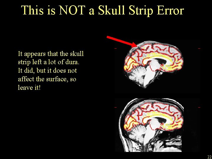 This is NOT a Skull Strip Error It appears that the skull strip left