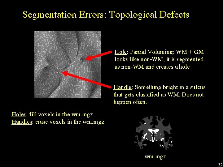 Segmentation Errors: Topological Defects Hole: Partial Voluming: WM + GM looks like non-WM, it