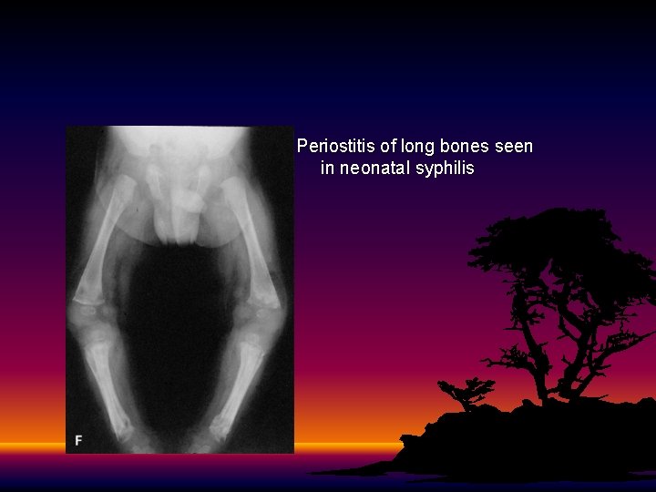 Periostitis of long bones seen in neonatal syphilis 