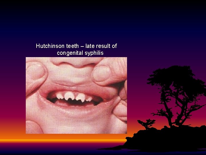 Hutchinson teeth – late result of congenital syphilis 