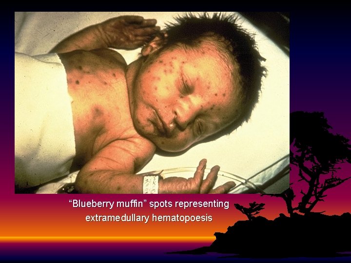 “Blueberry muffin” spots representing extramedullary hematopoesis 