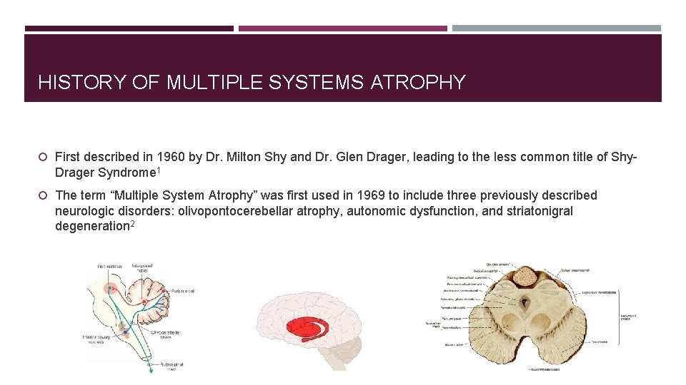 HISTORY OF MULTIPLE SYSTEMS ATROPHY First described in 1960 by Dr. Milton Shy and
