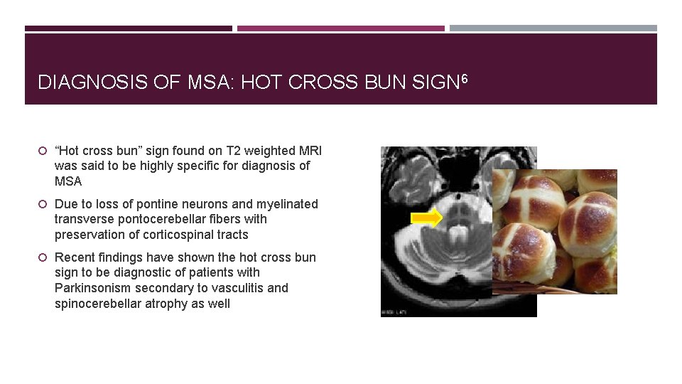 DIAGNOSIS OF MSA: HOT CROSS BUN SIGN 6 “Hot cross bun” sign found on
