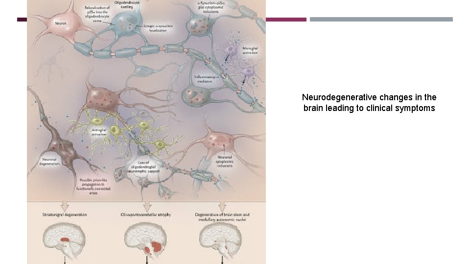 GLIAL CYTOPLASMIC INCLUSIONS Neurodegenerative changes in the brain leading to clinical symptoms 