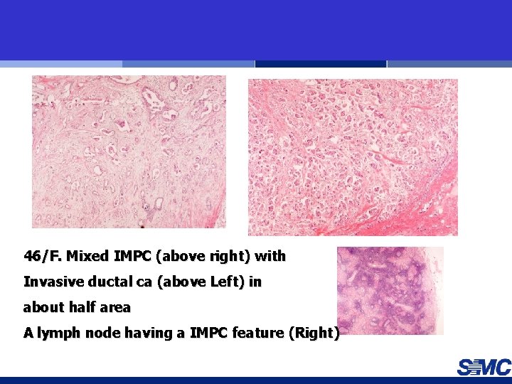 46/F. Mixed IMPC (above right) with Invasive ductal ca (above Left) in about half