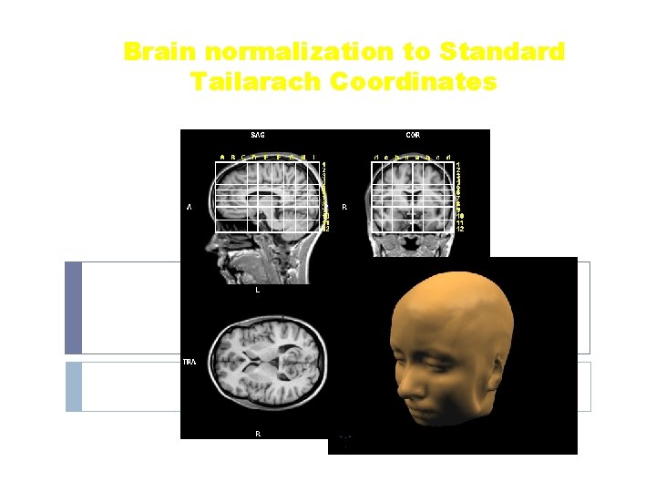 Brain normalization to Standard Tailarach Coordinates 