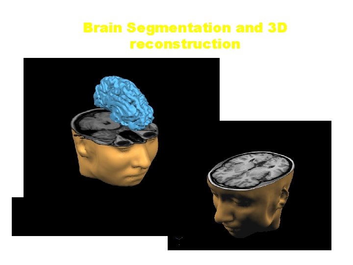 Brain Segmentation and 3 D reconstruction 