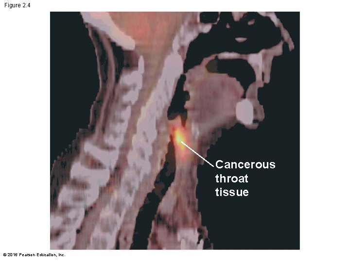 Figure 2. 4 Cancerous throat tissue © 2016 Pearson Education, Inc. 