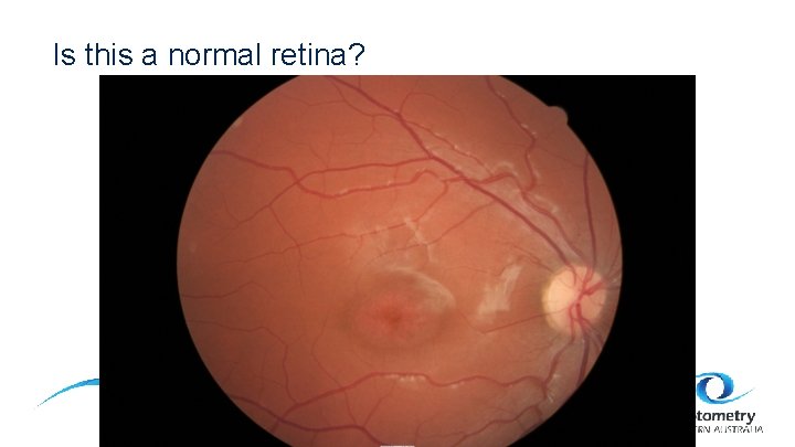 Is this a normal retina? 