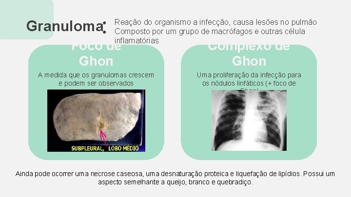 Granuloma ● ● Reação do organismo a infecção, causa lesões no pulmão Composto por