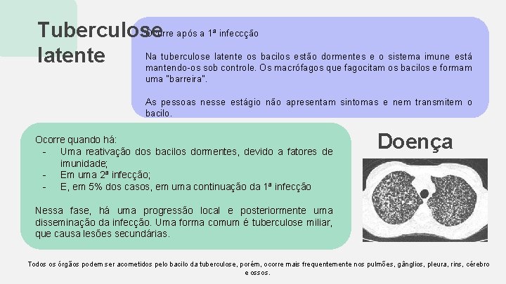 Ocorre após a 1ª infeccção Tuberculose Na tuberculose latente os bacilos estão dormentes e