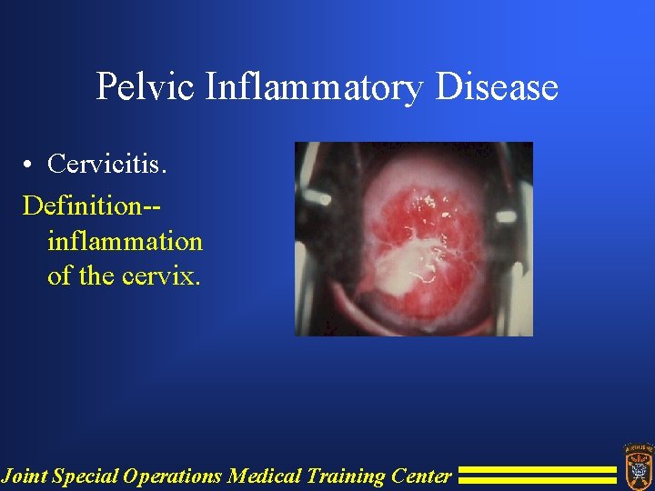 Pelvic Inflammatory Disease • Cervicitis. Definition-inflammation of the cervix. Joint Special Operations Medical Training