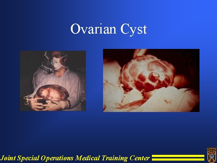 Ovarian Cyst Joint Special Operations Medical Training Center 