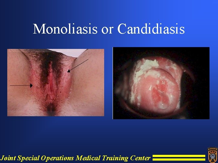 Monoliasis or Candidiasis Joint Special Operations Medical Training Center 