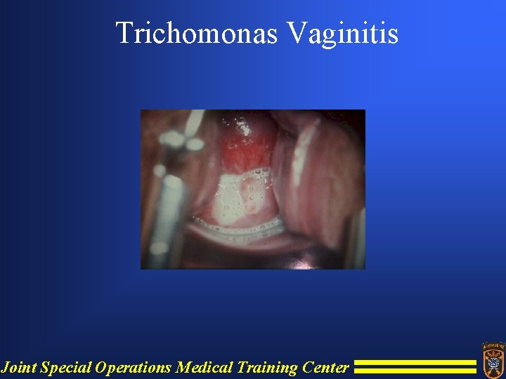 Trichomonas Vaginitis Joint Special Operations Medical Training Center 