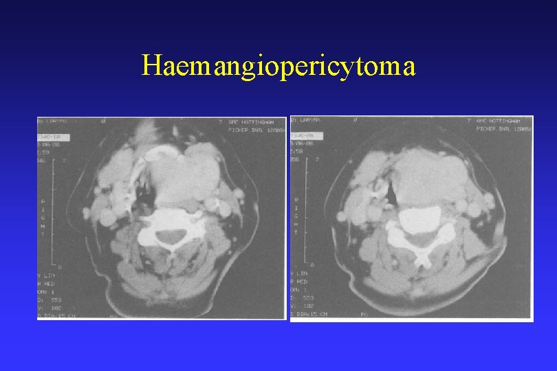 Haemangiopericytoma 