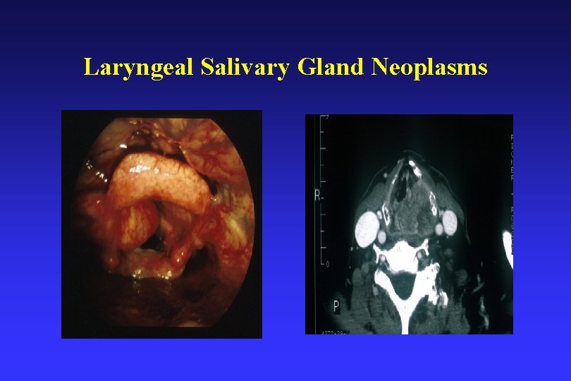 Laryngeal Salivary Gland Neoplasms 