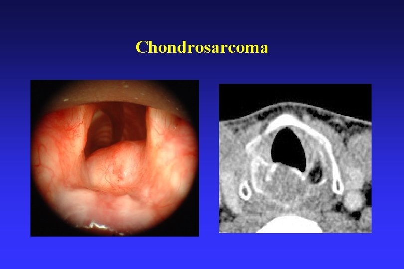 Chondrosarcoma 