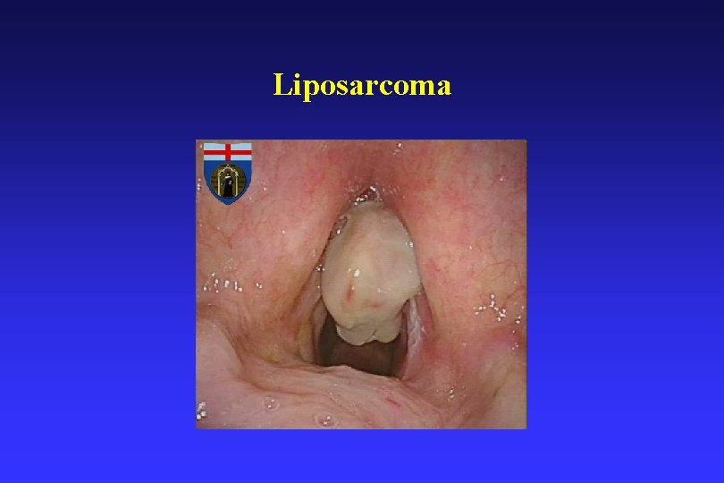 Liposarcoma 